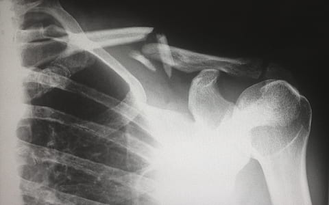 shoulder fracture x-ray thumbnail