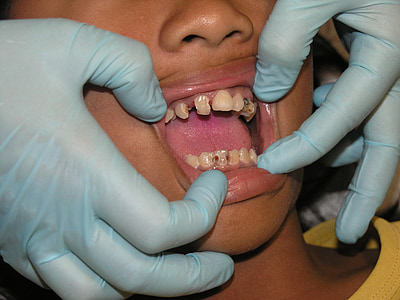 dentist looking the teeth of person thumbnail