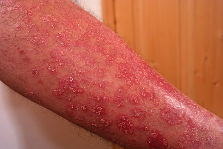 human skin condition thumbnail