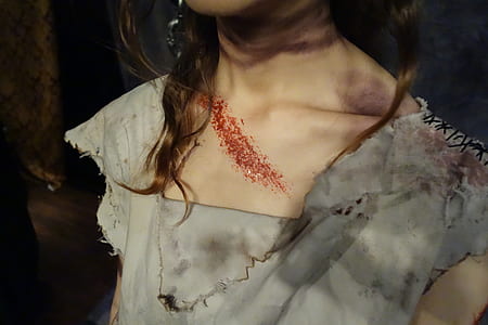 woman wearing white top with bruise thumbnail