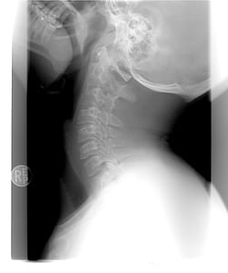 spine X-ray thumbnail