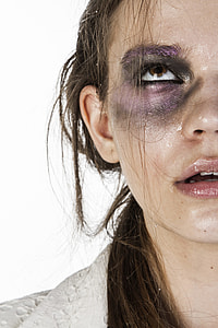 right woman eye with bruise thumbnail