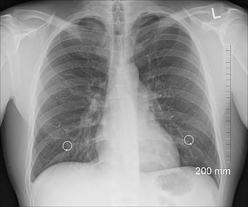 x-ray of a lungs thumbnail