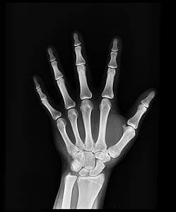black-and-white, hand, bones, x-ray thumbnail