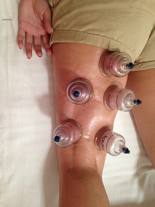 five ventosa glasses on person's back leg thumbnail