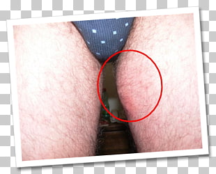 18 Ingrown Hair Png Cliparts For Free Download Uihere