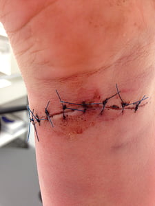 person showing right hand with stitches thumbnail