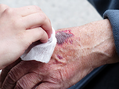 person treats person with bruise thumbnail