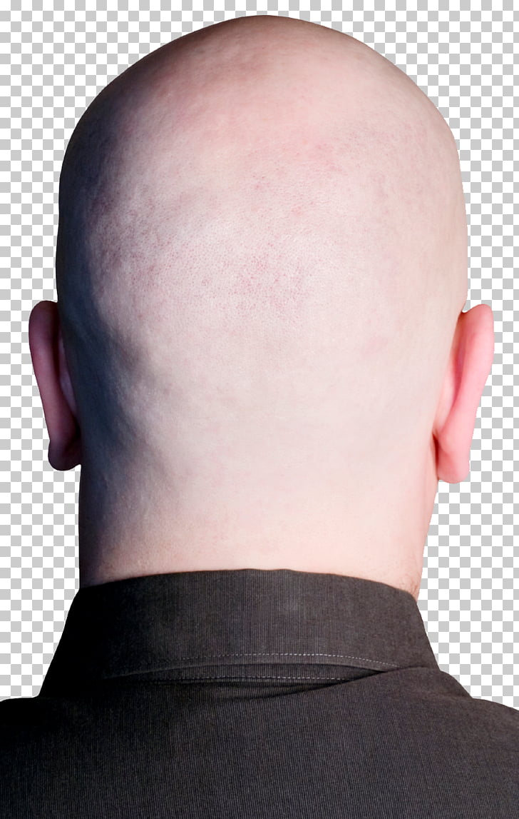 Forehead Chin Neck Hair Loss Back Png Clipart Free Cliparts