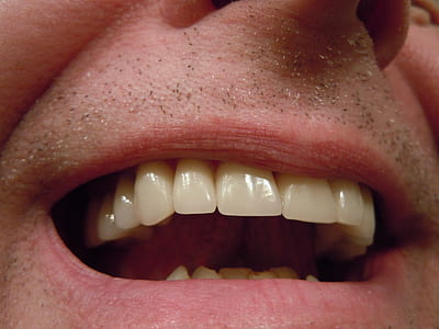 person's teeth thumbnail