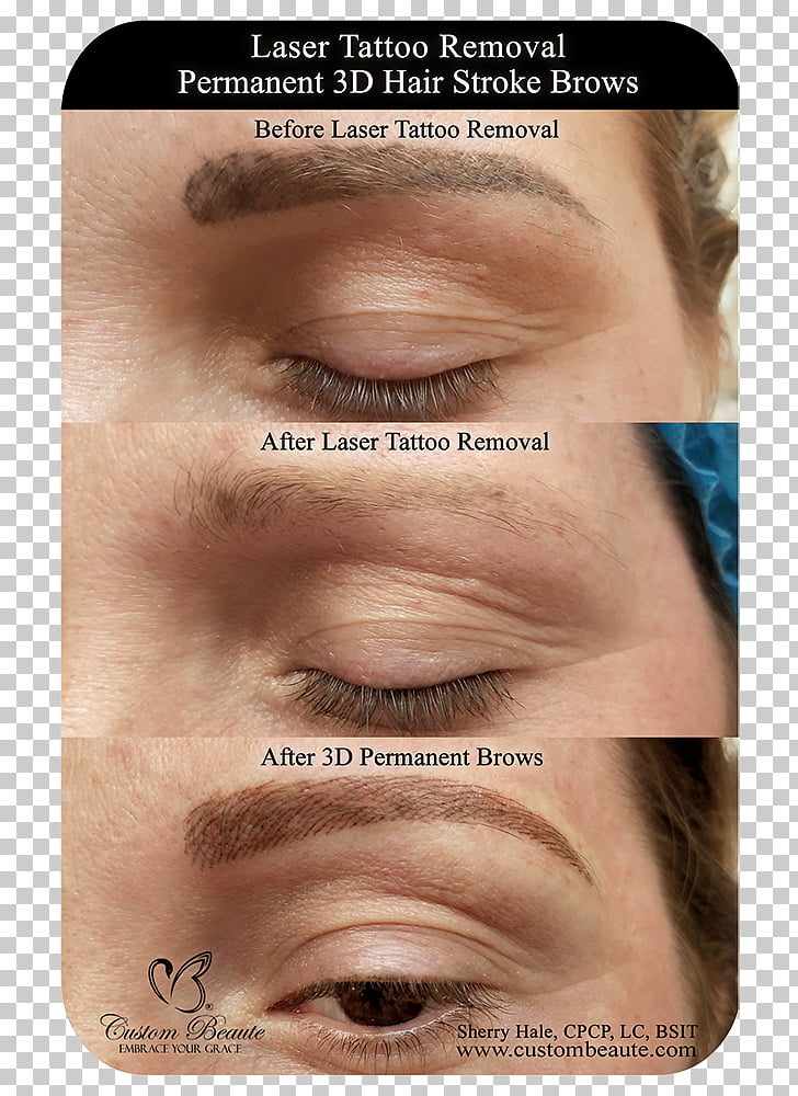 Eyebrow Tattoo Removal Permanent Makeup Laser Hair Png Clipart