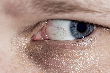 view of person's left eye thumbnail