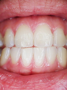 closeup photo of person's teeth thumbnail