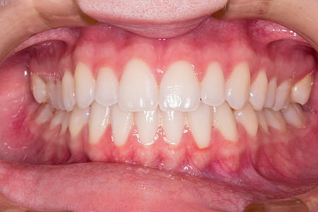 macro shot of person showing teeth thumbnail