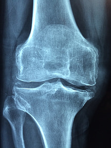 X-ray results on bone thumbnail