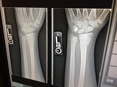 x-ray, medical, broken, arm, doctor, x ray thumbnail