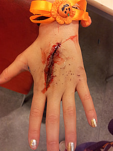 bleeding left hand thumbnail