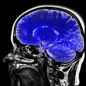 CT scan of human brain thumbnail
