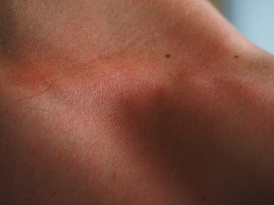 human skin condition thumbnail