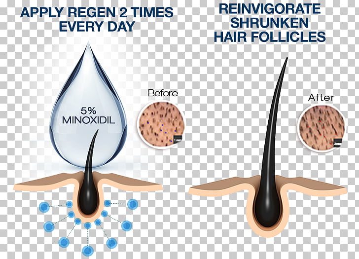 Minoxidil Management Of Hair Loss Hair Follicle Human Hair Growth