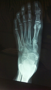 x-ray of left foot closeup photo thumbnail