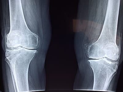photo of human leg knees x-ray results thumbnail