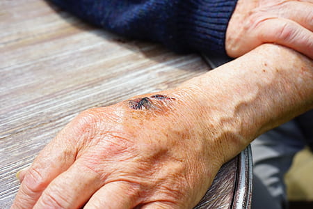 person showing left hand skin condition thumbnail