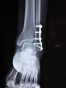bone ultrasound result thumbnail
