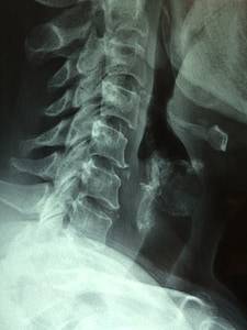 closeup photo of human neck X-ray thumbnail