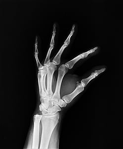 hand X-ray thumbnail