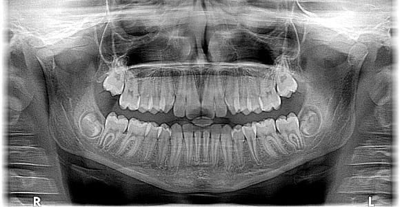 x-ray photo of the human skull thumbnail