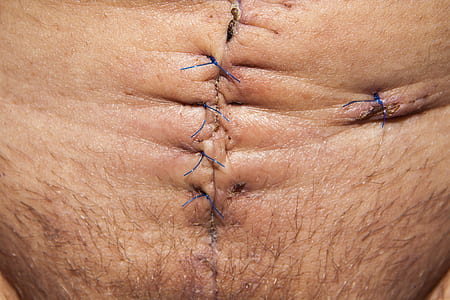 closeup of human's tummy with stitches thumbnail