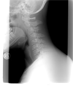 neck X-ray thumbnail