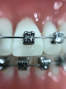 silver teeth braces thumbnail