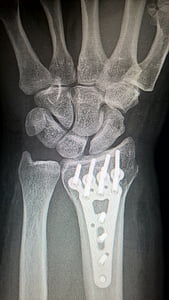 x-ray of arm thumbnail