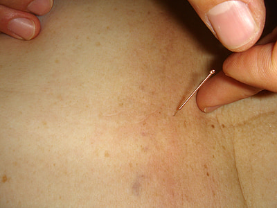 close up photo of acupuncture pin thumbnail