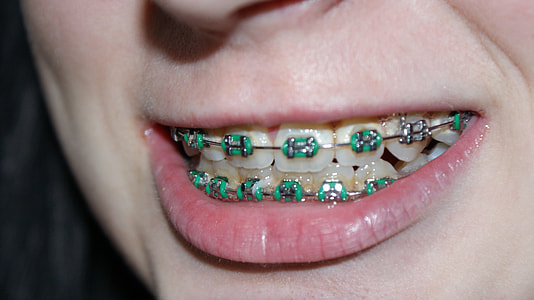 person with green teeth braces thumbnail
