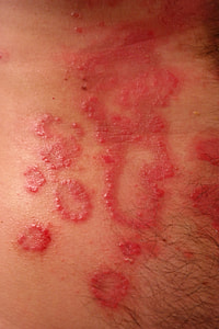 human skin condition thumbnail